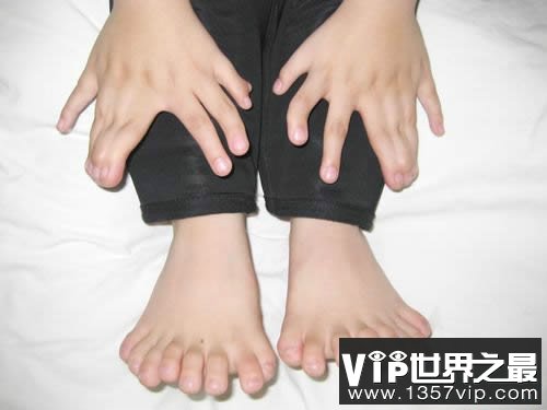 世界上手指脚趾最多的人，印度婴儿14个手指/20脚趾(www.5300tv.com)