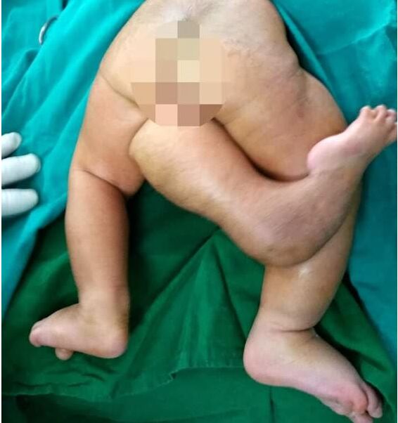 印度女婴一出生就有“三条腿” 医生通过手术给她切除一个