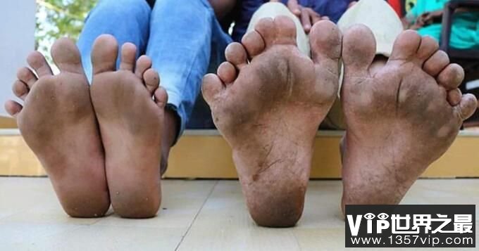 世界上脚趾最多的人：印度小男孩20根脚趾(患有多指症)