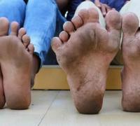 世界上脚趾最多的人：印度小男孩20根脚趾(患有多指症)