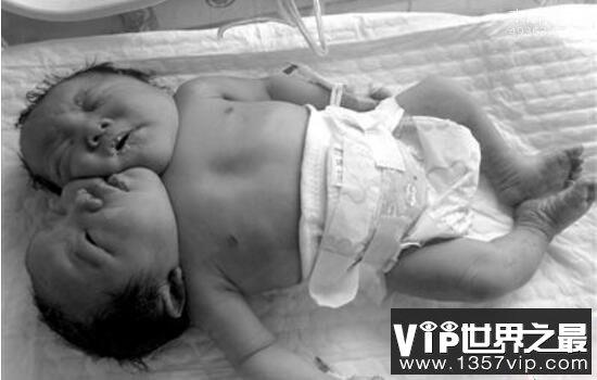 巴西双头婴儿，两百年内出现过14例