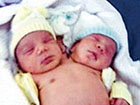 巴西双头婴儿，两百年内出现过14例