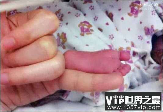 世界上最小的婴儿阿米利娅·泰勒:出生仅280克(今年14岁)