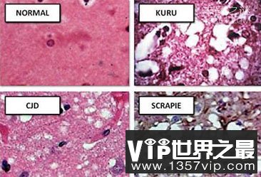 库鲁病是什么病，库鲁病的蔓延竟是食用尸体的结果