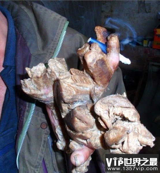 树人刘忠文现状，手脚长满恐怖树枝(生活已不能自理)