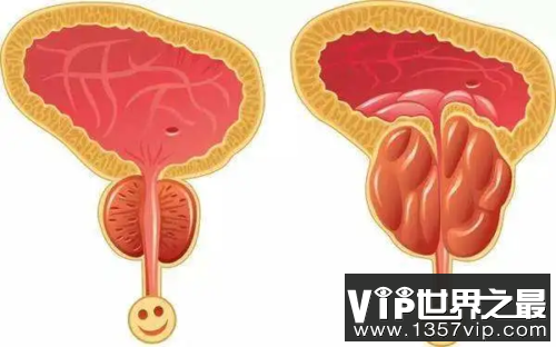 男性前列腺炎能过性生活吗