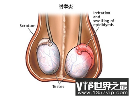 引起附睾睾丸炎的原因