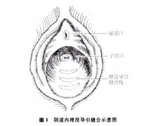 收紧