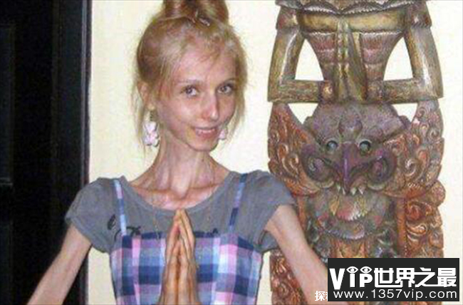 世界上最瘦的女性 俄罗斯少女仅为20公斤(因厌食症)