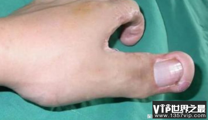 世界上最大的手指 食指的长度达到30厘米(影响较大)