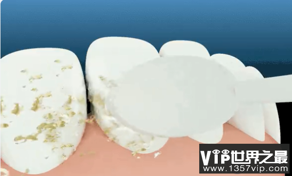 牙菌斑过多的表现有哪些 牙齿长牙菌斑了怎么办