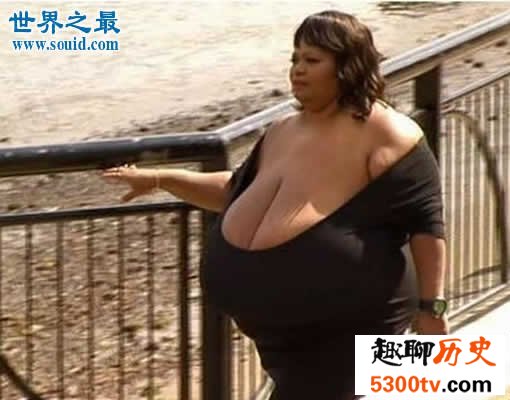 世界上最大的天然乳房，双乳重达77斤(图)